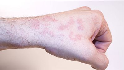 علامات مبكرة تنذرك بإصابتك بسرطان الجلد