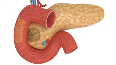 تغير لون البول أول علامات الإصابة بسرطان البنكرياس