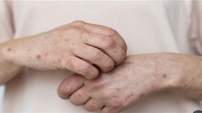 جدري القرود ليس مرعبًا (شاهد)