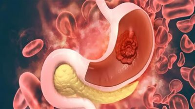 سرطان المعدة.. علامات الوجه إنذار بالخطر