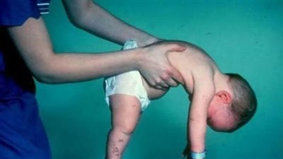 ضمور العضلات.. وباء يطحن عظام الغلابة