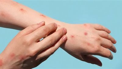 طرق الوقاية من جدري القرود والفئات الأكثر عرضة