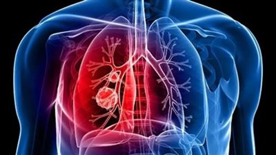 خبراء ينفون شائعة عن سرطان الرئة