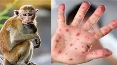 الصحة تكشف حقيقة انتشار جدري القرود وطرق العدوى