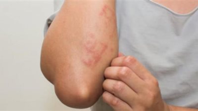 فيتنام تعلن تسجيل أول إصابة بجدري القرود