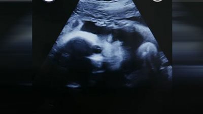 ولادة طفلة تحمل جنينًا في بطنها بالدقهلية| فيديو