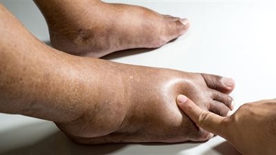 5 طرق للتخلص من احتباس الماء في الجسم