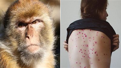 تطورات الحالة الصحية لمصابي جدري القرود بمصر (فيديو)