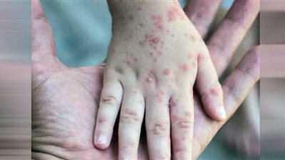 آخر تطورات مرض جدري القرود عالميًا