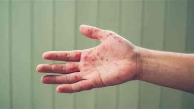 السودان أحدث المتضررين.. 6 دول عربية ضربها جدري القرود