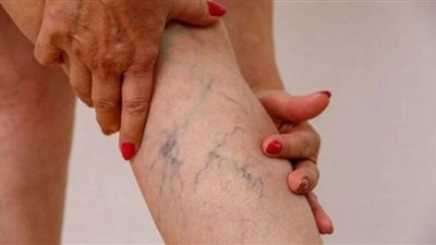 إليكِ 7 خطوات للتخلص من الدوالي نهائيًا
