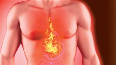 طبيب يوضح طرق بسيطة للتخلص من حرقة المعدة