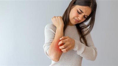 الإكزيما.. طبيبة أمراض جلدية تحذر من كارثة حول المرض