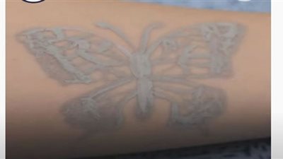 تاتو إلكتروني يراقب صحة الإنسان (شاهد)