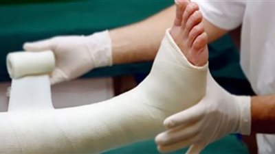 كسور العظام في الطفولة تزيد من خطر هشاشتها في المستقبل