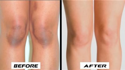 علاج اسمرار الركبة| وصفة طبيعية تمنحك الثقة من جديد