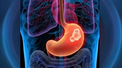 أطعمة للوقاية من سرطان المعدة