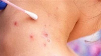 ولاية كاليفورنيا تعلن حالة الطوارئ بسبب جدري القرود