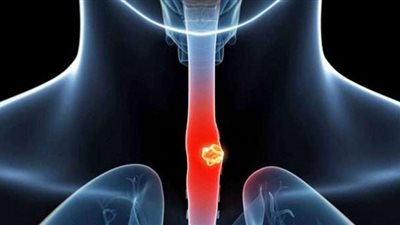 أول علامة لسرطان المريء.. انتبه لها