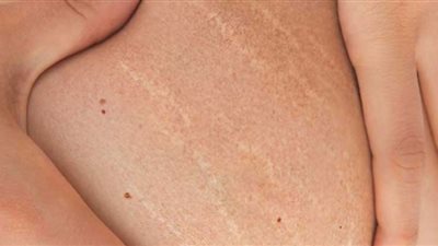 السيلوليت يحمي النساء من أمراض خطيرة