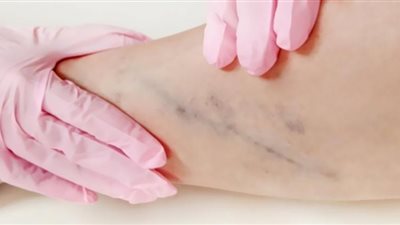 3 مشروبات تزيد من مخاطر الإصابة بجلطات الدم