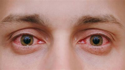 احمرار العين يكشف إصابتك بمرض خطير