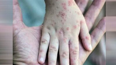 إمكانية إصابة الأطفال بجدري القرود