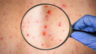 الأشخاص المعرضون لخطر الإصابة بجدري القرود‏