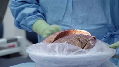 نجاح جراحة زراعة الرئة نصر كبير لمصر