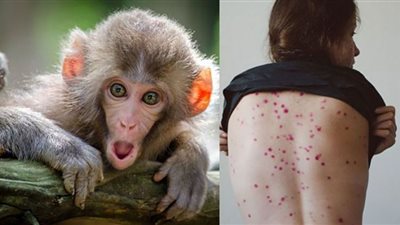 أطباء يكشفون سبب تَفشي جدرى القرود