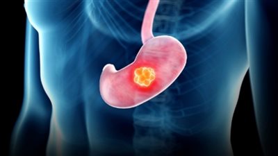 علامة في عينيك تنذرك بسرطان المعدة