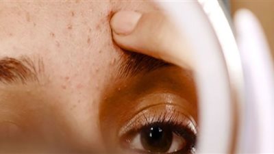 أسباب ظهور بثور الوجه عند الإصابة بالإنفلوانزا