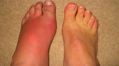 عصائر شائعة تثير نوبات داء الملوك