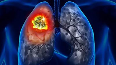 السعال المزمن أبرز أعراض سرطان الرئة.. أطباء يوضحون