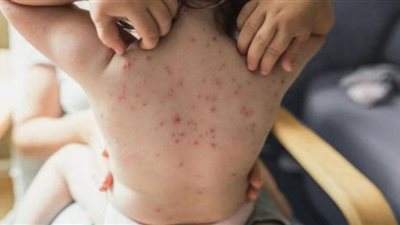 طريقة انتقال جدرى القرود من شخص لآخر