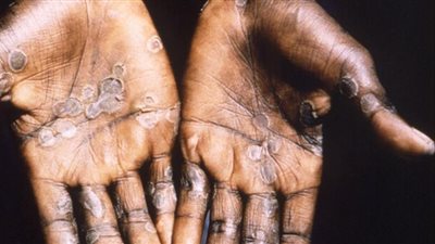 جدرى القرود يهدد 6 دول إفريقية