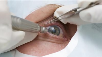 زرع قرنية اصطناعية لعشرين مريضا لأول مرة