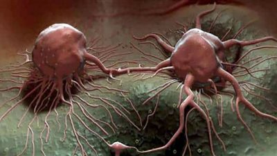 توفير لقاح لعلاج السرطان عام 2030 (شاهد)