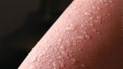 إرشادات لوقاية الجلد من حروق الشمس (انفوجراف)