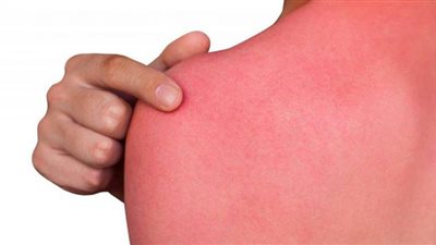 تطوير طريقة حديثة لعلاج الحروق بالأكسجين