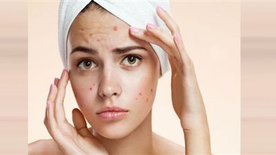 اقضِ على حب الشباب بمكون واحد فقط