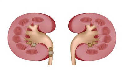 أخطر أنواع حصى الكلى.. طبيب يوضح