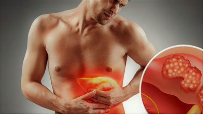 ضعف وفقدان شهية.. أبرز علامات الإصابة بسرطان الكبد