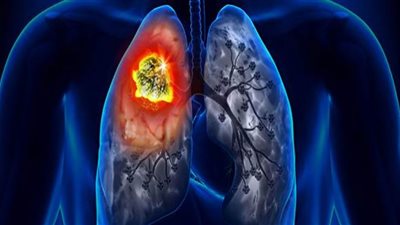 علامة من علامات سرطان الرئة تحدد سبب الوفاة .. اعرفها