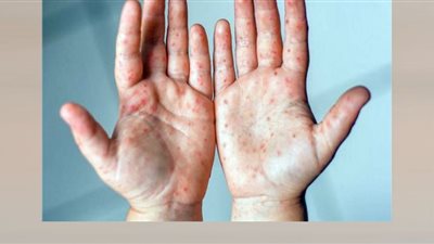 رصد أول إصابة بجدري القرود في إيران