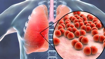 منها السعال.. أعراض مرض السل