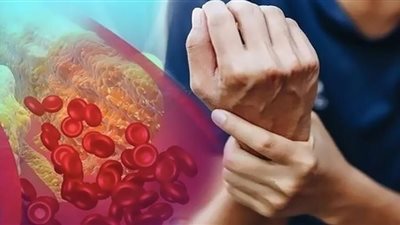 علماء يثبتون علاقة الخرف بارتفاع مستوى الكوليسترول