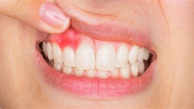 أسباب التهاب اللثة وطرق الوقاية منها
