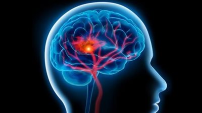 أصحاب هذه الفصيلة أكثر عرضة للإصابة بسكتة دماغية