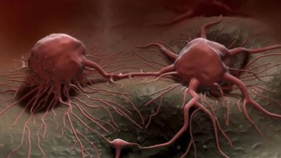 أطباء يعالجون السرطان باستخدام أشعة جاما